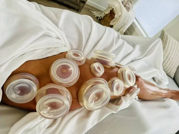 Cupping Therapy